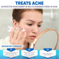 AOBBIY 12% Azelaic Acid Acne Cream, 1 Oz